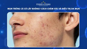 mụn trứng cá có lây không