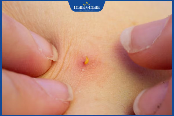 mụn trứng cá có mủ