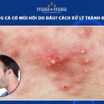 mụn trứng cá có mùi hôi