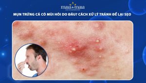 mụn trứng cá có mùi hôi