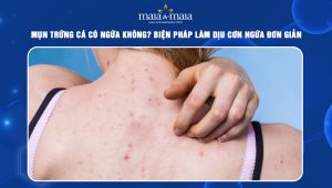 mụn trứng cá có ngứa không