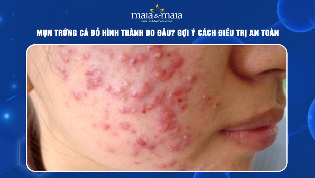 mụn trứng cá đỏ