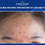 mụn trứng cá mọc đối xứng