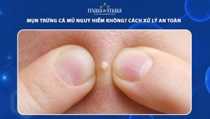mụn trứng cá mủ