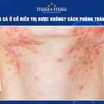 mụn trứng cá ở cổ