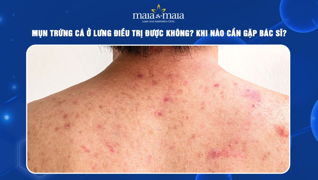 mụn trứng cá ở lưng