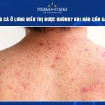 mụn trứng cá ở lưng