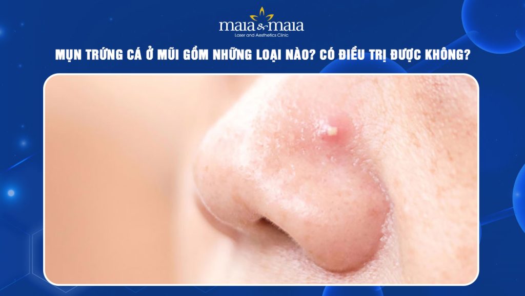 mụn trứng cá ở mũi