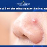 mụn trứng cá ở mũi