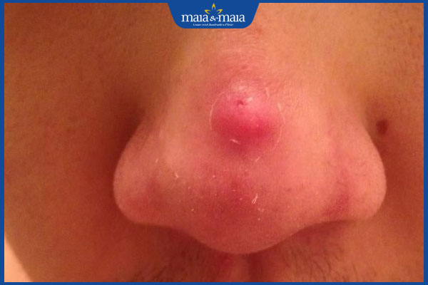 mụn trứng cá ở mũi sưng lớn