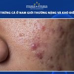 mụn trứng cá ở nam giới
