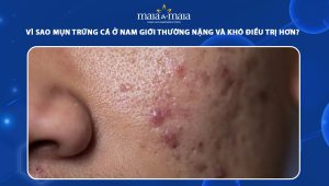 mụn trứng cá ở nam giới