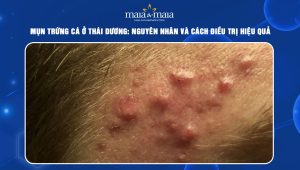 mụn trứng cá ở thái dương