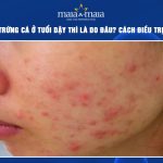 mụn trứng cá ở tuổi dậy thì