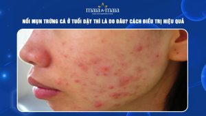 mụn trứng cá ở tuổi dậy thì