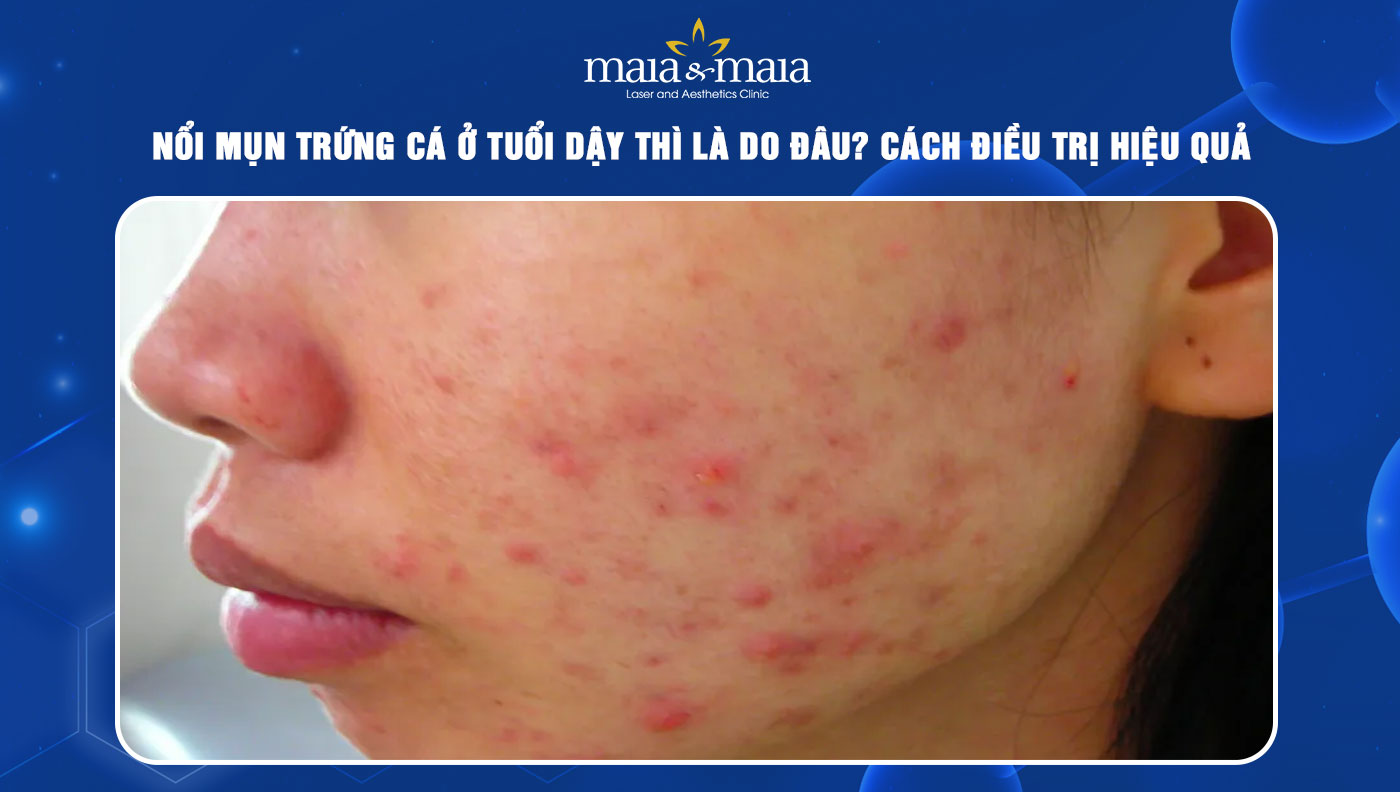 mụn trứng cá ở tuổi dậy thì