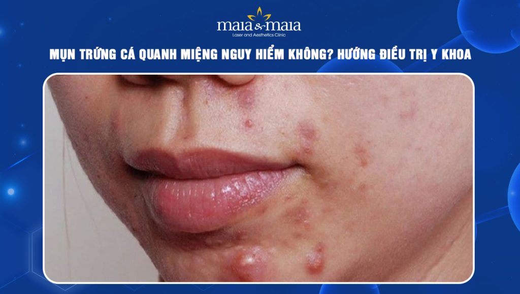 mụn trứng cá quanh miệng