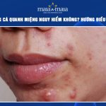 mụn trứng cá quanh miệng