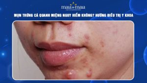 mụn trứng cá quanh miệng