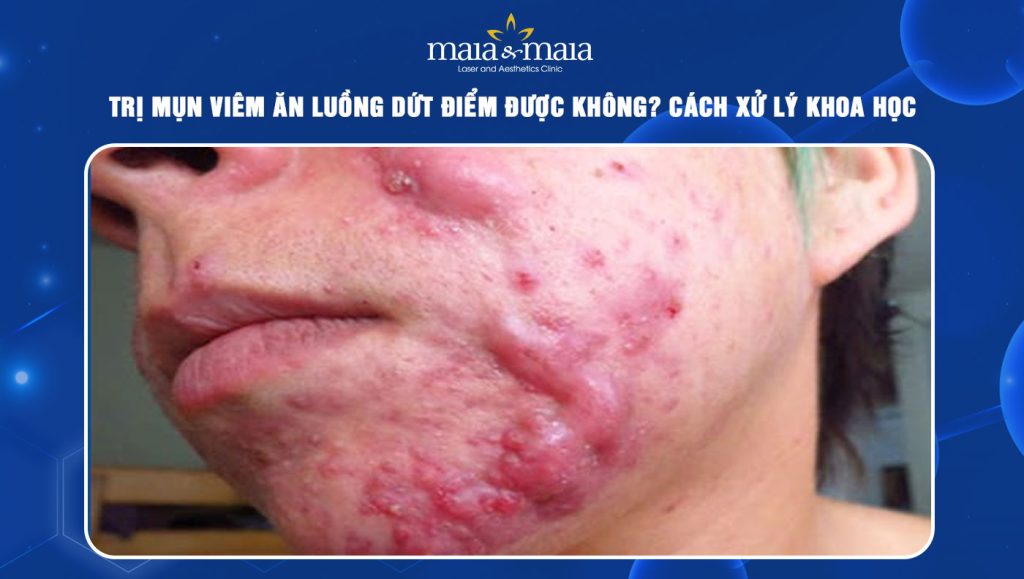 mụn viêm ăn luồng