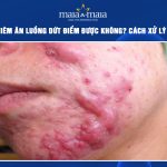 mụn viêm ăn luồng