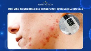 mụn viêm có nên dùng bha