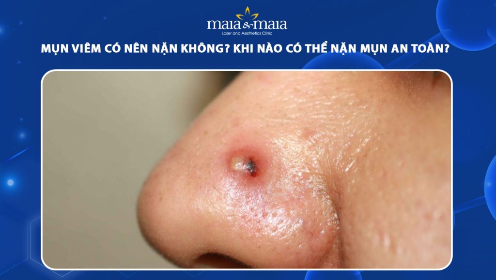 mụn viêm có nên nặn không