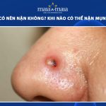 mụn viêm có nên nặn không