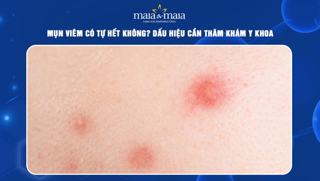 mụn viêm có tự hết không