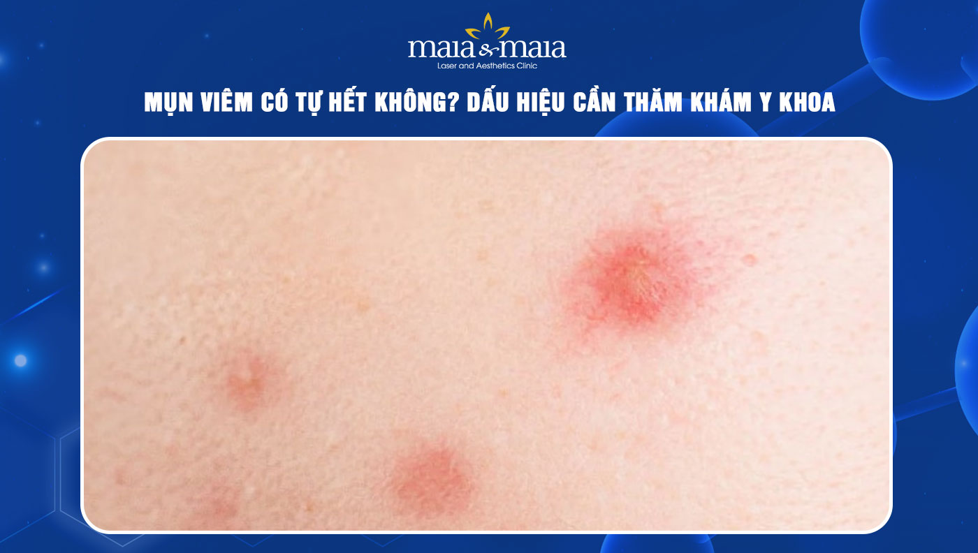 mụn viêm có tự hết không