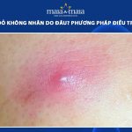 mụn viêm đỏ không nhân
