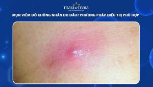 mụn viêm đỏ không nhân
