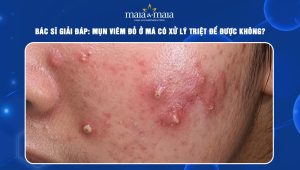 mụn viêm đỏ ở má