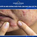 mụn viêm dưới da