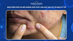 mụn viêm dưới da