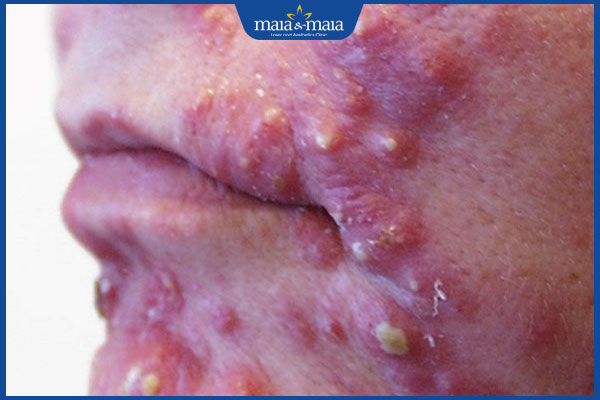 mụn viêm sưng lớn