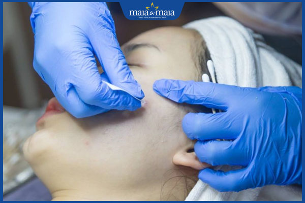 Nặn mụn trứng cá thế nào là đúng kỹ thuật? Cần lưu ý gì? 3 nặn mụn chuẩn y khoa