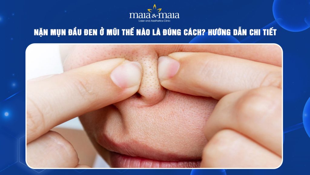 Nặn mụn đầu đen ở mũi thế nào là đúng cách? Hướng dẫn chi tiết 1 nặn mụn đầu đen ở mũi