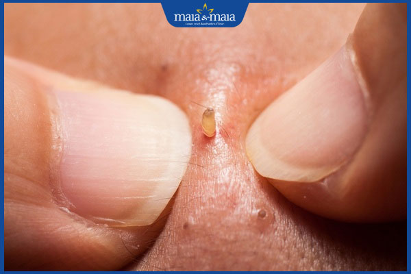 Nặn mụn đầu đen ở mũi thế nào là đúng cách? Hướng dẫn chi tiết 2 nặn mụn đầu đen