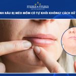 nặn mụn đinh râu bị méo mồm