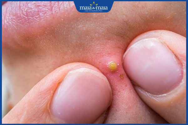 nặn nốt mụn viêm