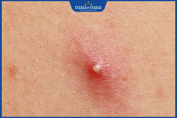 Mụn trứng cá bao lâu thì chín? Cách xử lý mụn chín chuẩn y khoa 2 nhân mụn thấy rõ