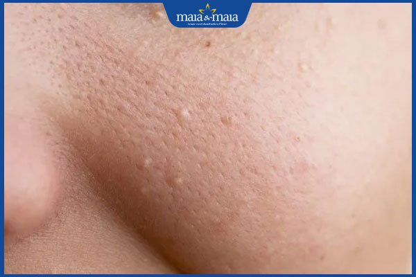 nổi mụn ẩn ở má