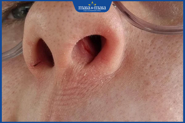 nổi mụn ẩn ở mũi