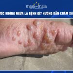 nổi mụn nước không ngứa