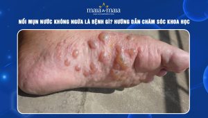 nổi mụn nước không ngứa
