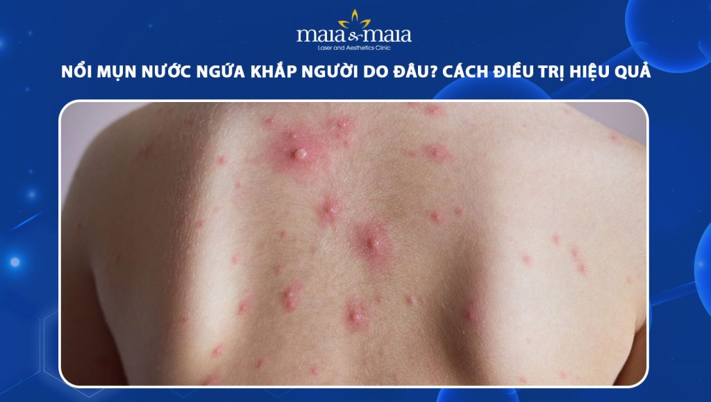 nổi mụn nước ngứa khắp người