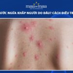 nổi mụn nước ngứa khắp người