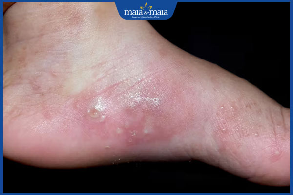 nổi mụn nước ở chân