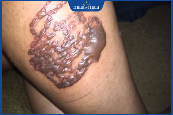 Hình xăm bị nổi mụn nước có sao không? Cách khắc phục an toàn 2 nổi mụn nước sau khi xăm hình